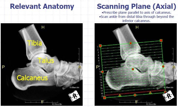 CT اسکن زانو ، مچ و پا 