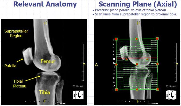 CT اسکن زانو ، مچ و پا 