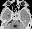 CT Scan سینوس و غده هیپوفیز