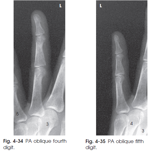 تکنیکهای رادیوگرافی انگشتان دست 2 تا 5